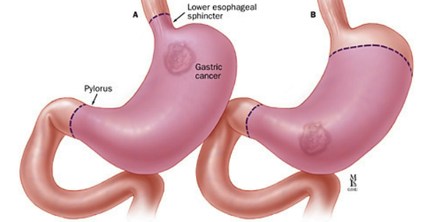 Gastric Cancer