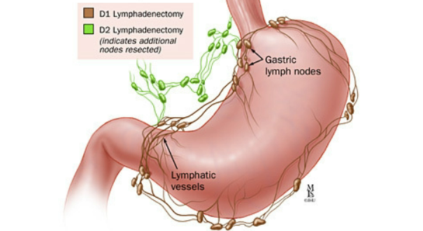 Gastric Cancer