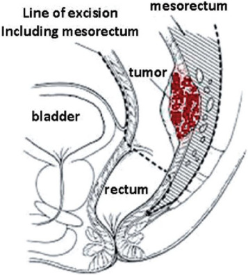 total mesorectal excision