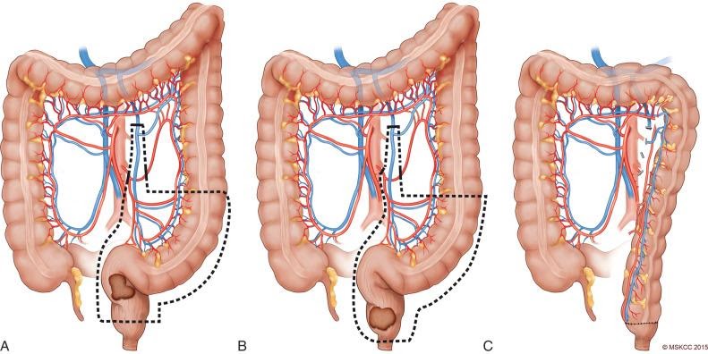 GI and Colorectal Cancer