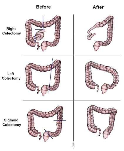 Colorectal Surgery